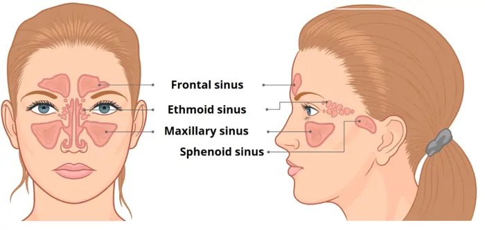 Diagram of frontal, ethmoid, maxillary, and sphenoid sinuses for chronic sinusitis education